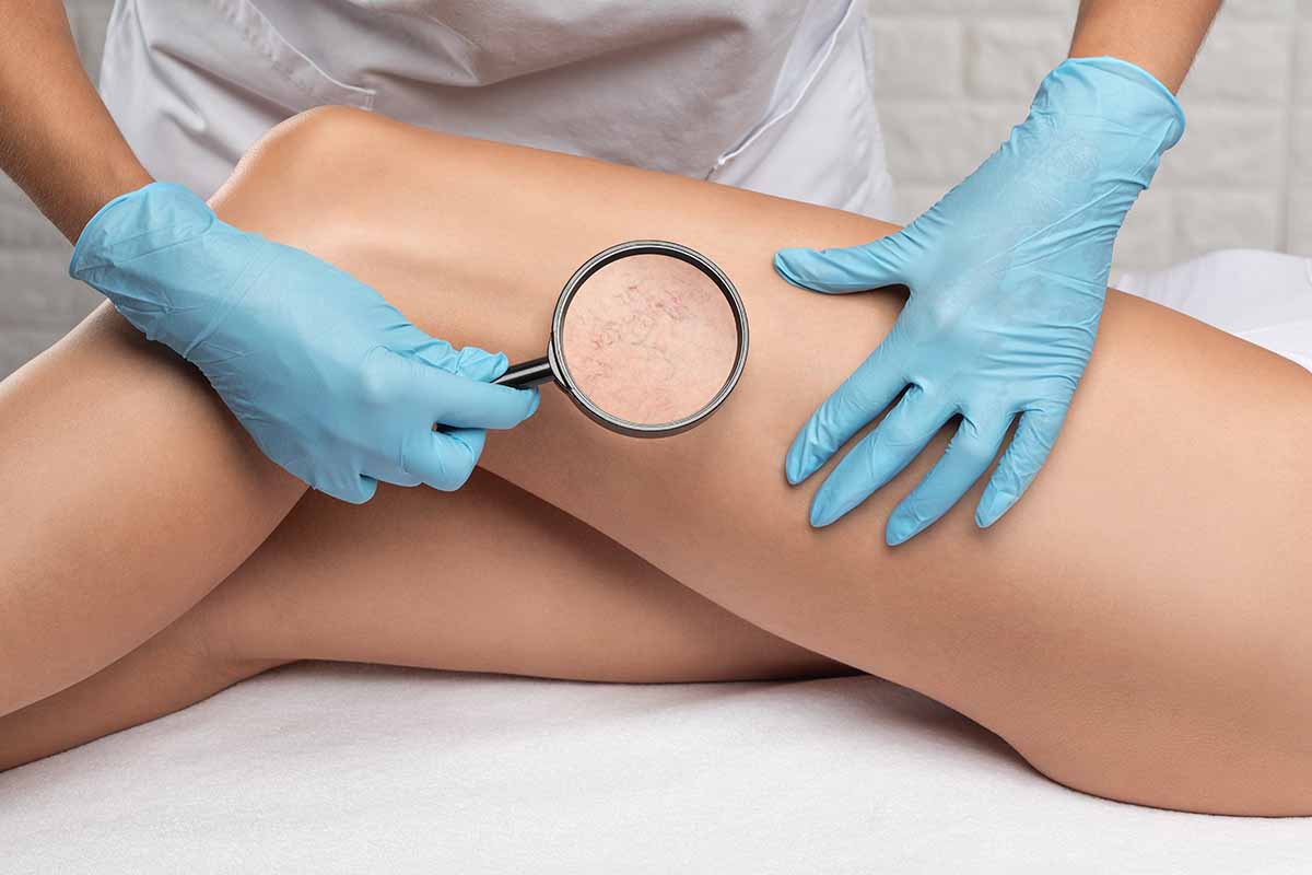 Capillari rotti nelle gambe: le possibili cause