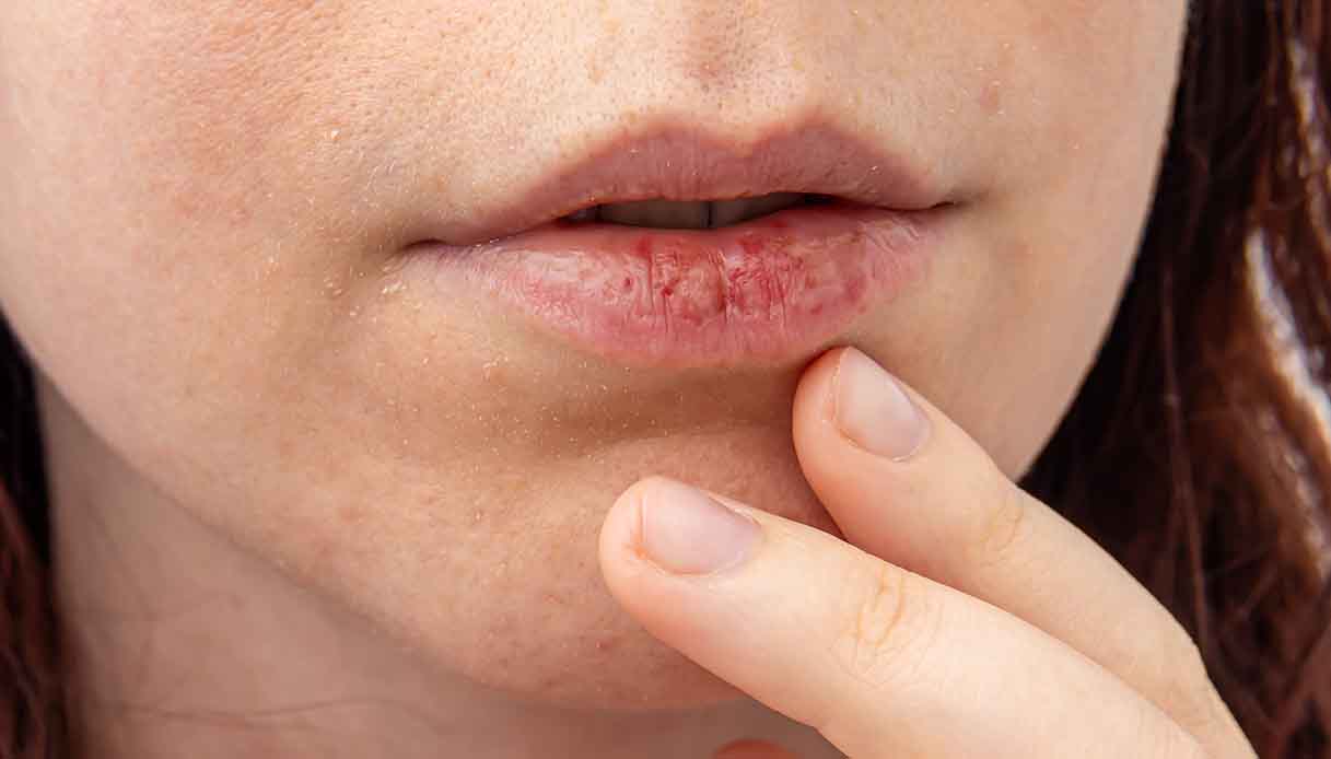 Come far passare velocemente le labbra screpolate