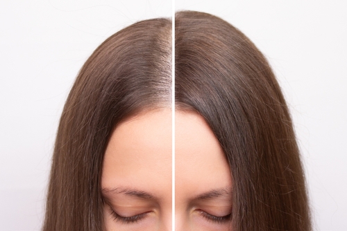 Trapianto diretto di capelli, perché è sempre più diffuso tra le donne e come funziona