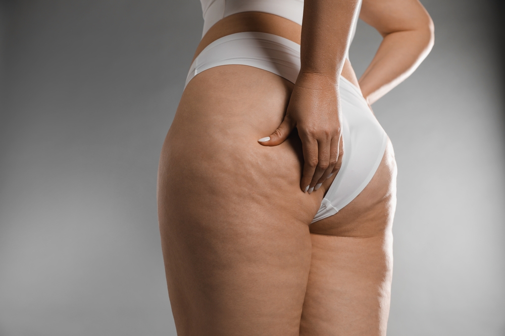 Ritenzione idrica o cellulite? Ecco come distinguere i due inestetismi