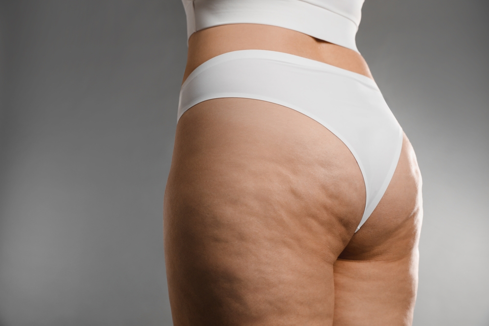 Cellulite edematosa o fibrosa? Come riconoscerla e scegliere il trattamento giusto