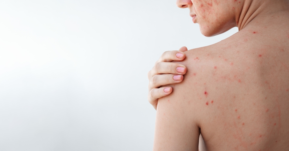 Acne corporea, cause e tipi