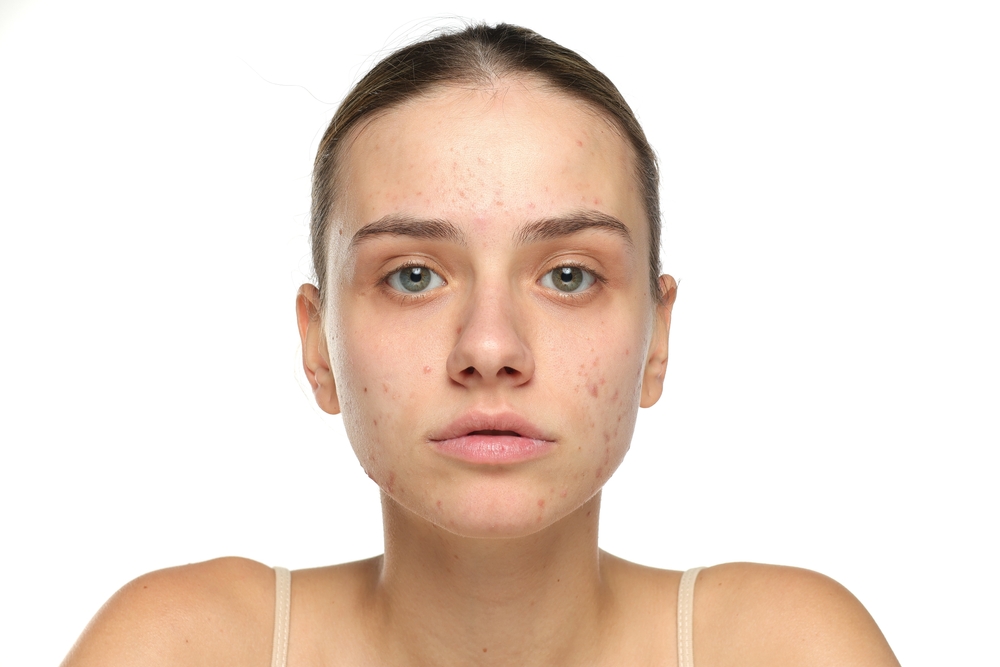Come prevenire l’acne durante l’adolescenza