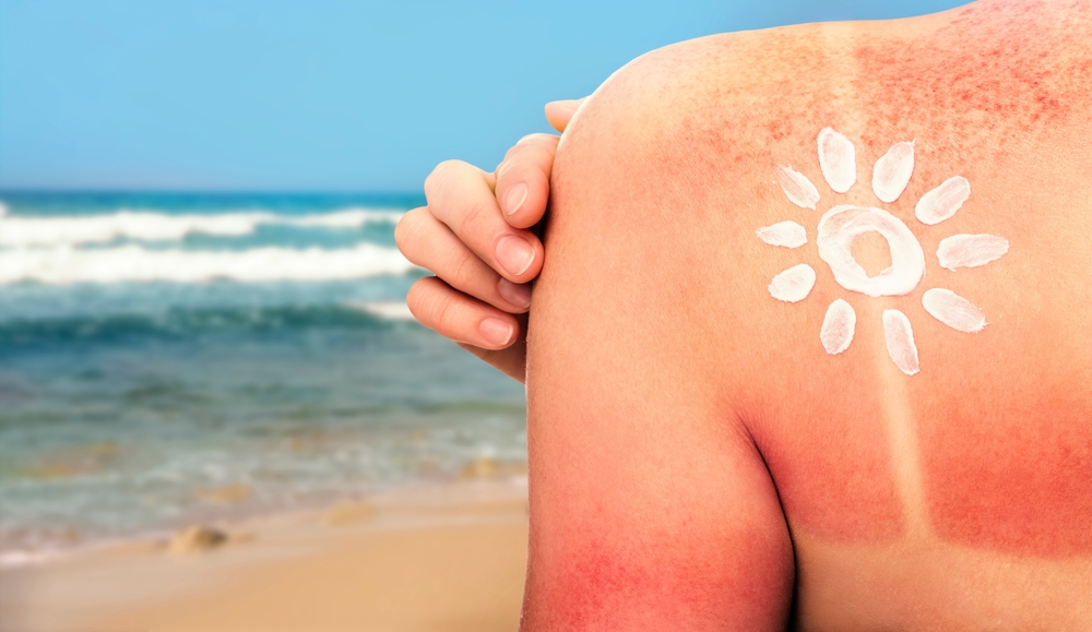 Eritema o scottatura solare? Come si distinguono e come si curano