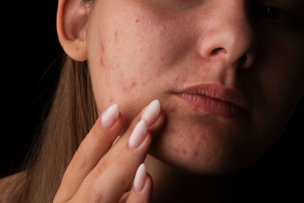 Come curare le cicatrice dell’acne