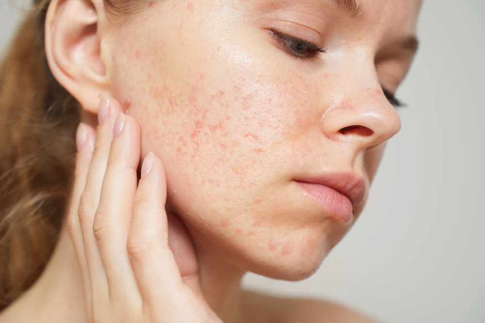 Come impostare una skincare per pelle grassa e acneide