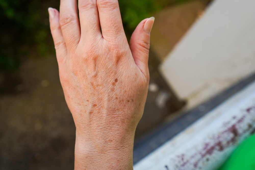 Come rimuovere le macchie scure dalle mani