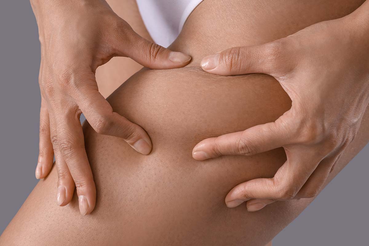 Quale trattamento anti cellulite scegliere