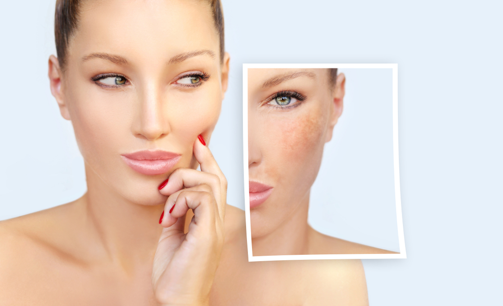 Laser Clear + Brilliant contro le rughe e le macchie del viso