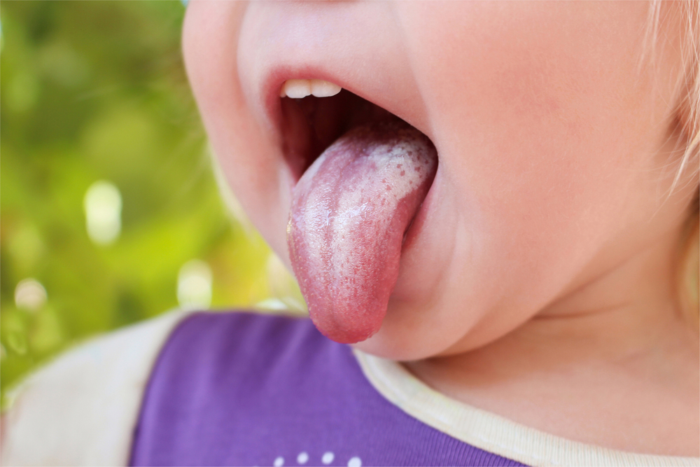 Mughetto nei bambini: sintomi e prevenzione
