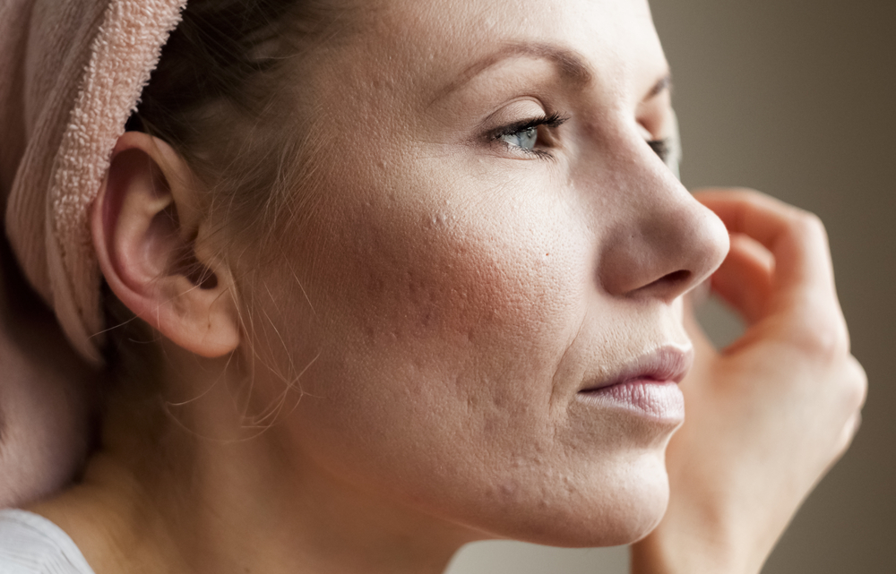 2 trattamenti che funzionano davvero contro l’acne