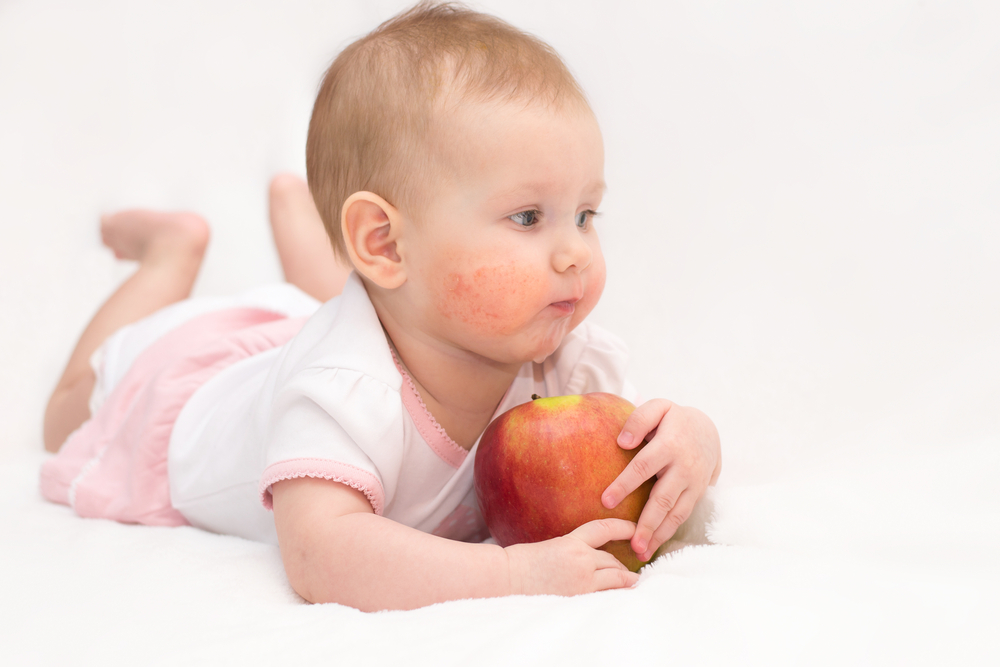 Eczema nei bambini, quali cibi preferire