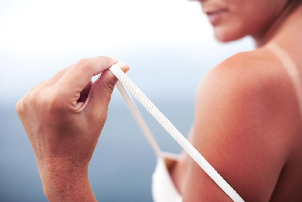 Come curare la pelle scottata dal sole