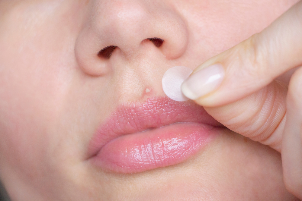 Come prevenire i brufoli sulle labbra?