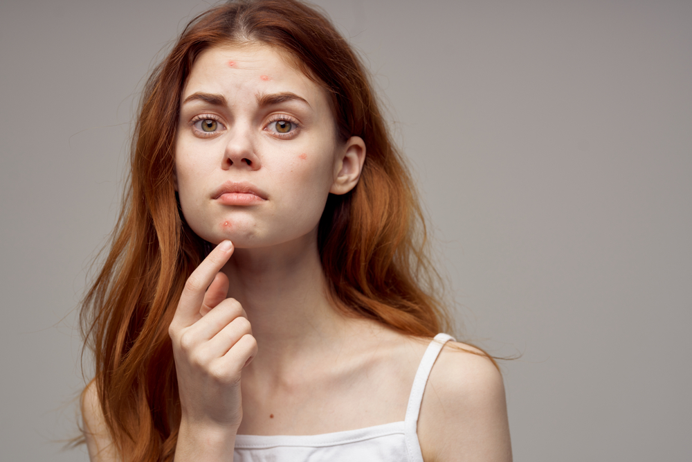 Quali sono i cibi che possono causare l’acne?